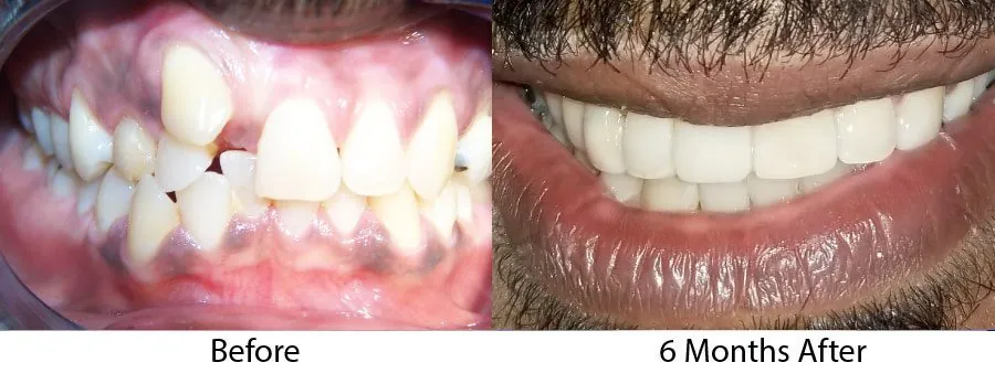 Before and after result with cosmetic finishing after six-month treatment