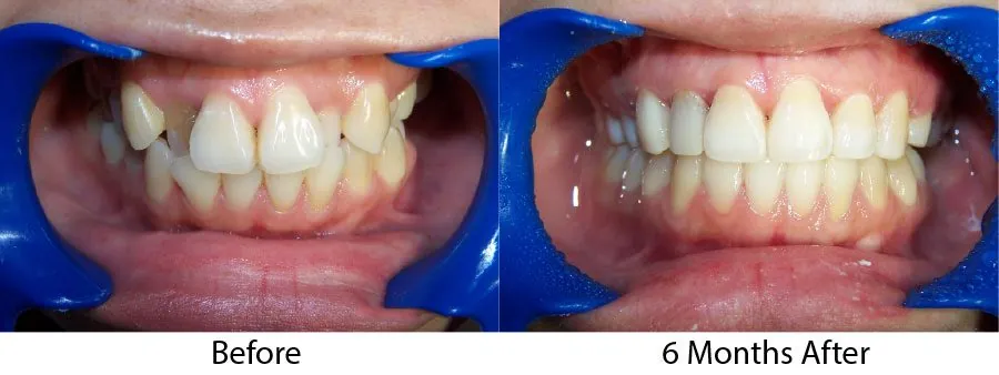 Patient smile shown before treatment and six months after braces