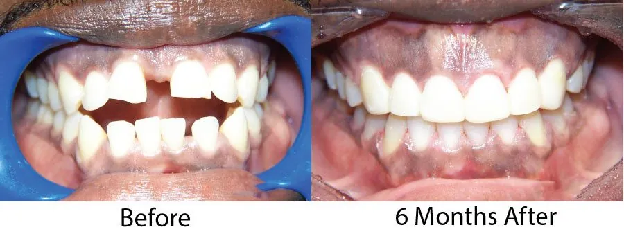 Before and after of an adult orthodontic case completed in half a year