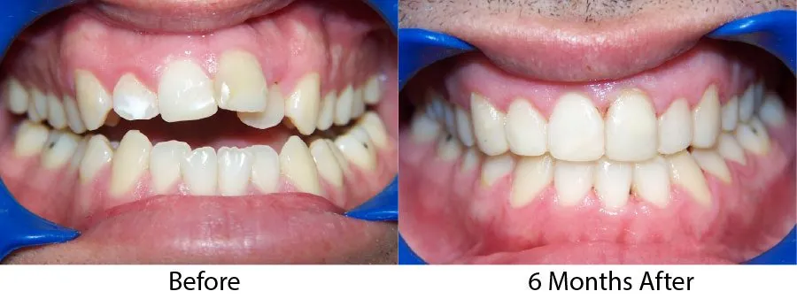 Smile gallery photo pair showing a six-month braces result