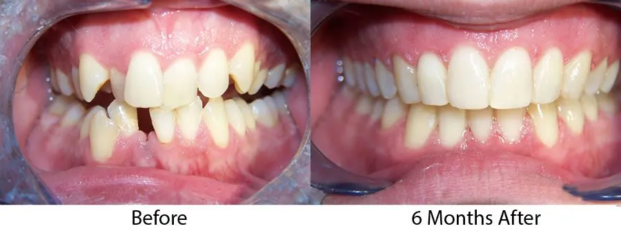 Before and after close-up of front teeth straightened in six months